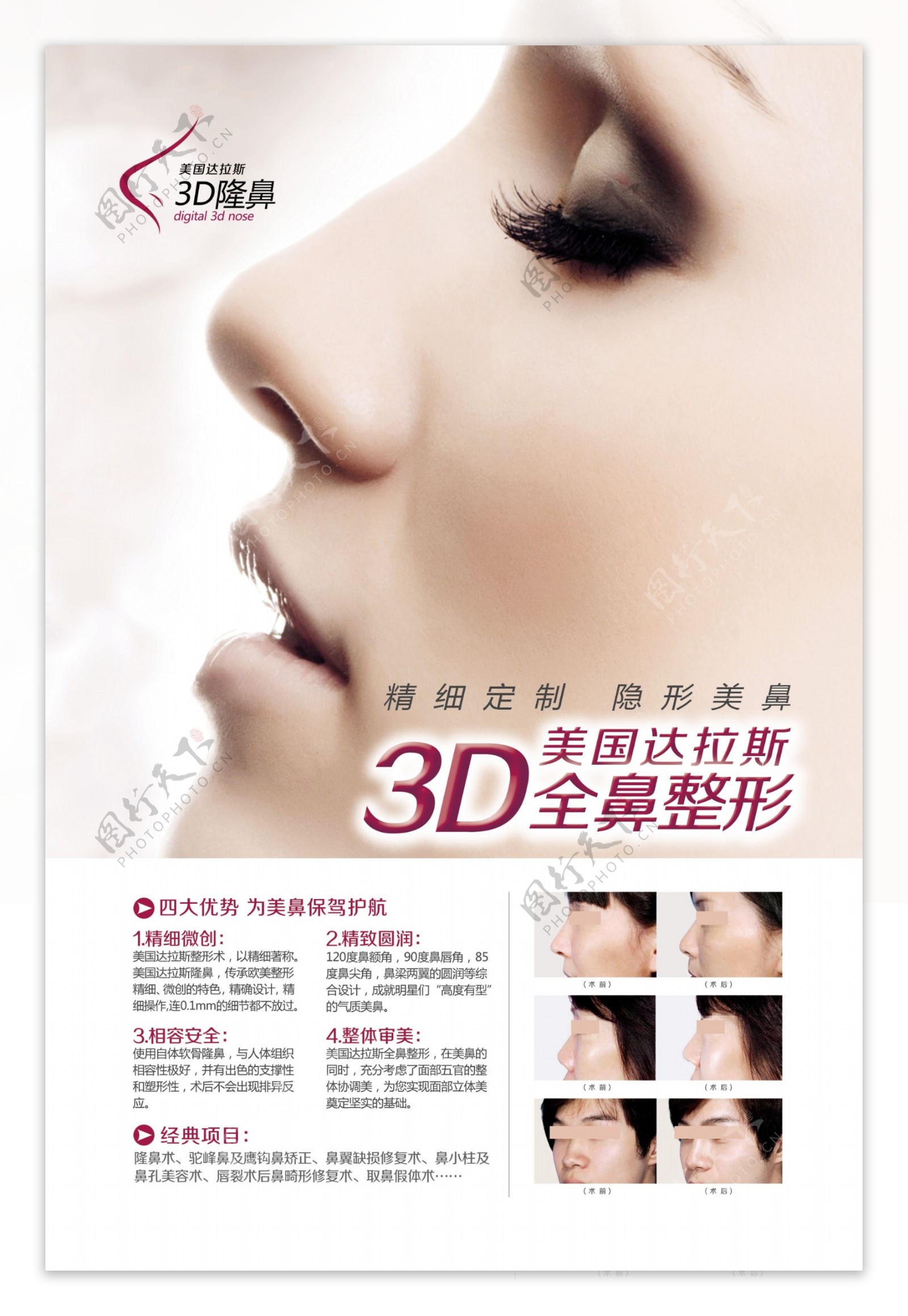 3D全鼻整形术