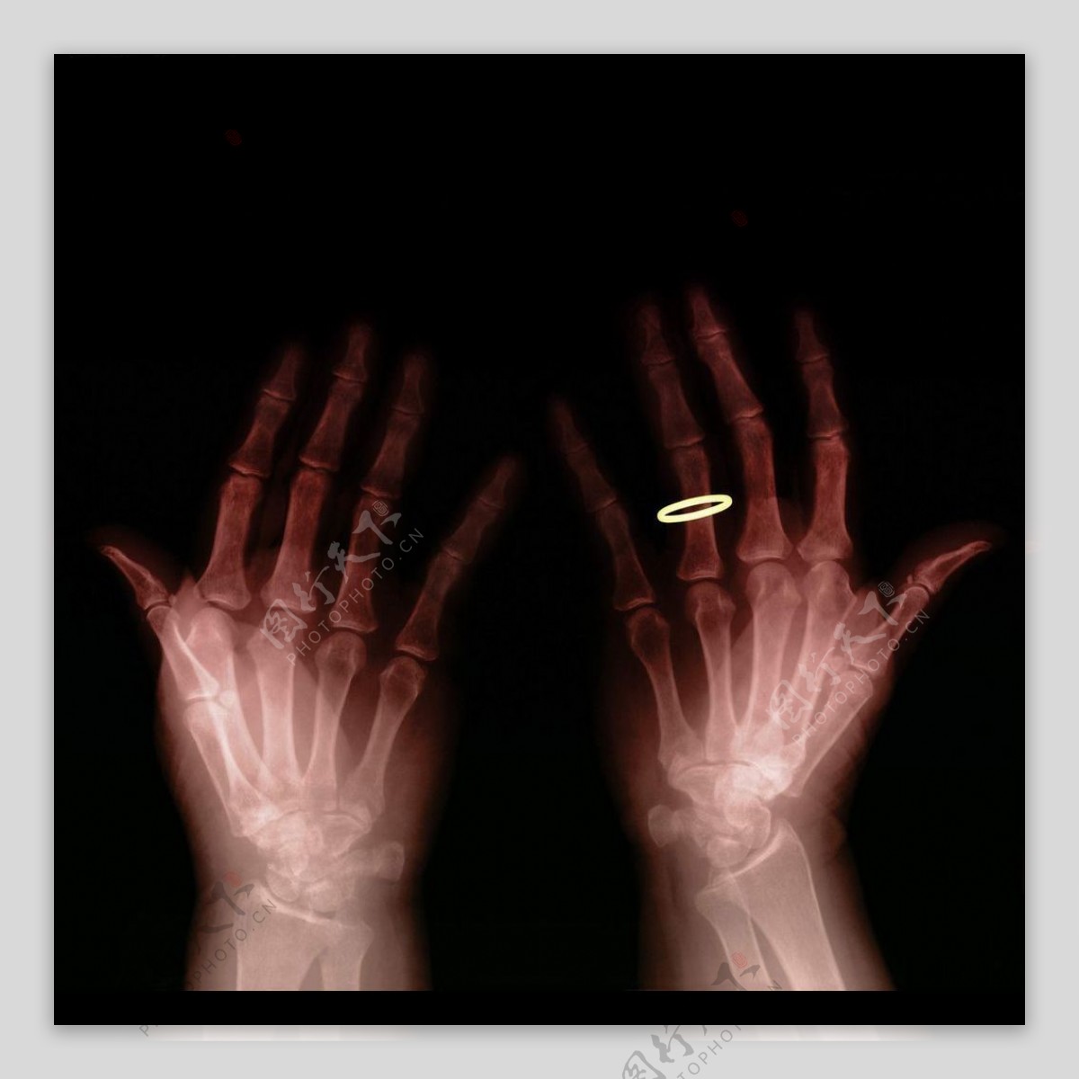 带戒指的手X光照图片