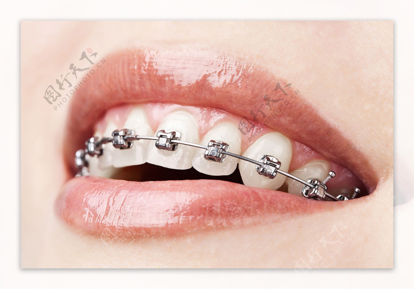 隐形牙齿矫正器和传统牙套 你选哪个 - 贝色口腔