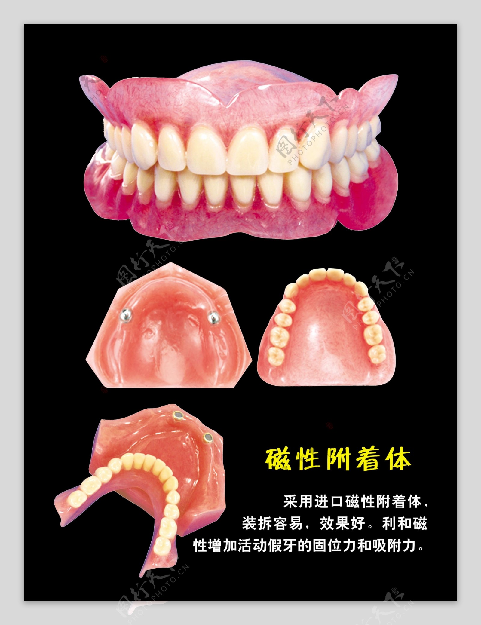 磁性附着体牙科