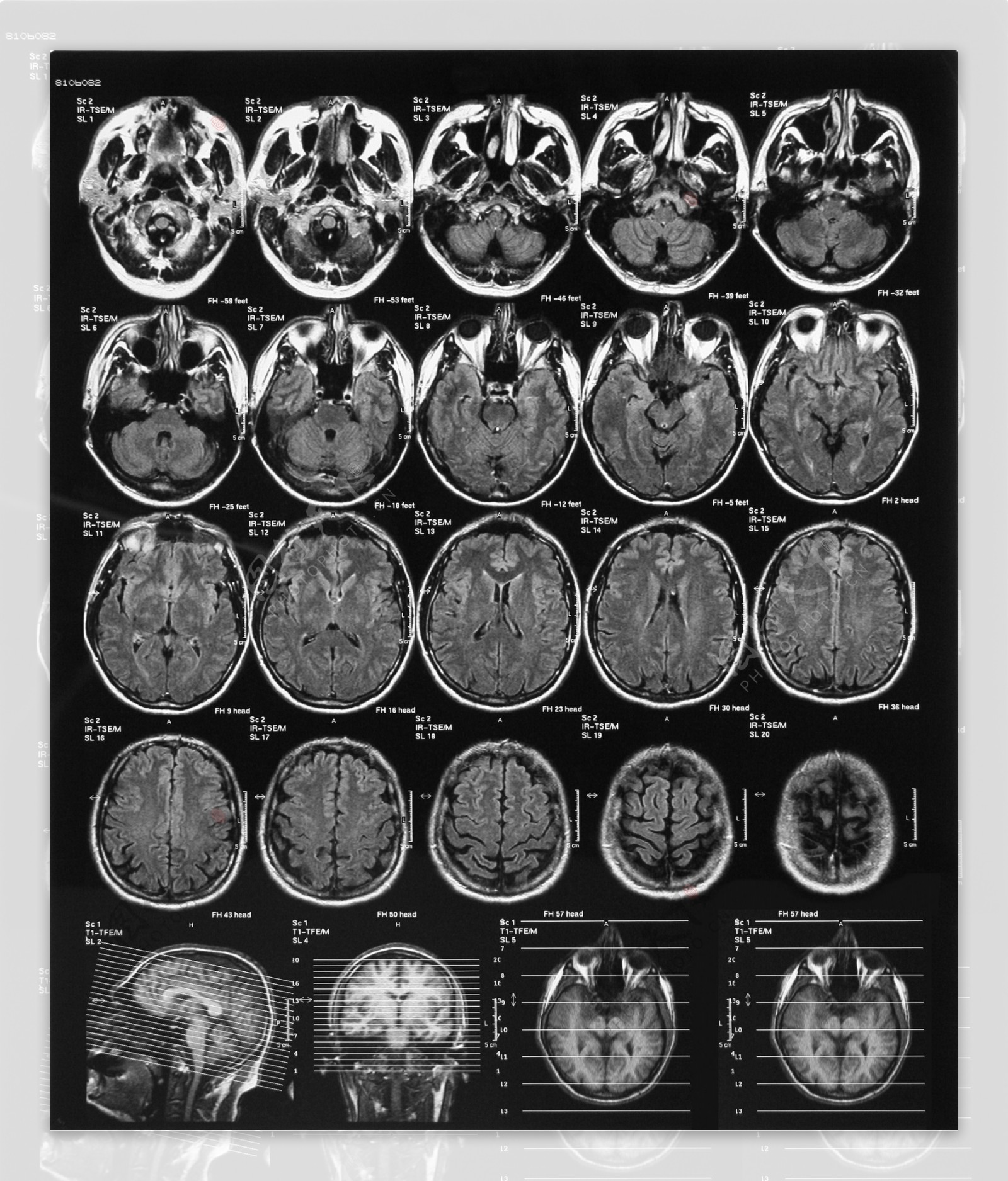 大脑的X线计算机断层扫描