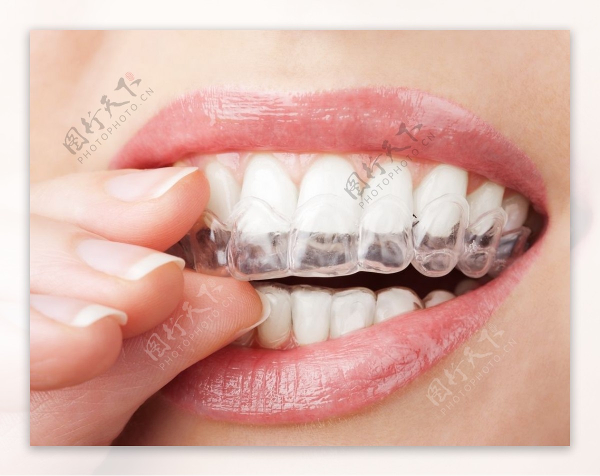 Sze的箍牙日記: 箍牙分享(八) 主要箍上排及之前剥智慧牙