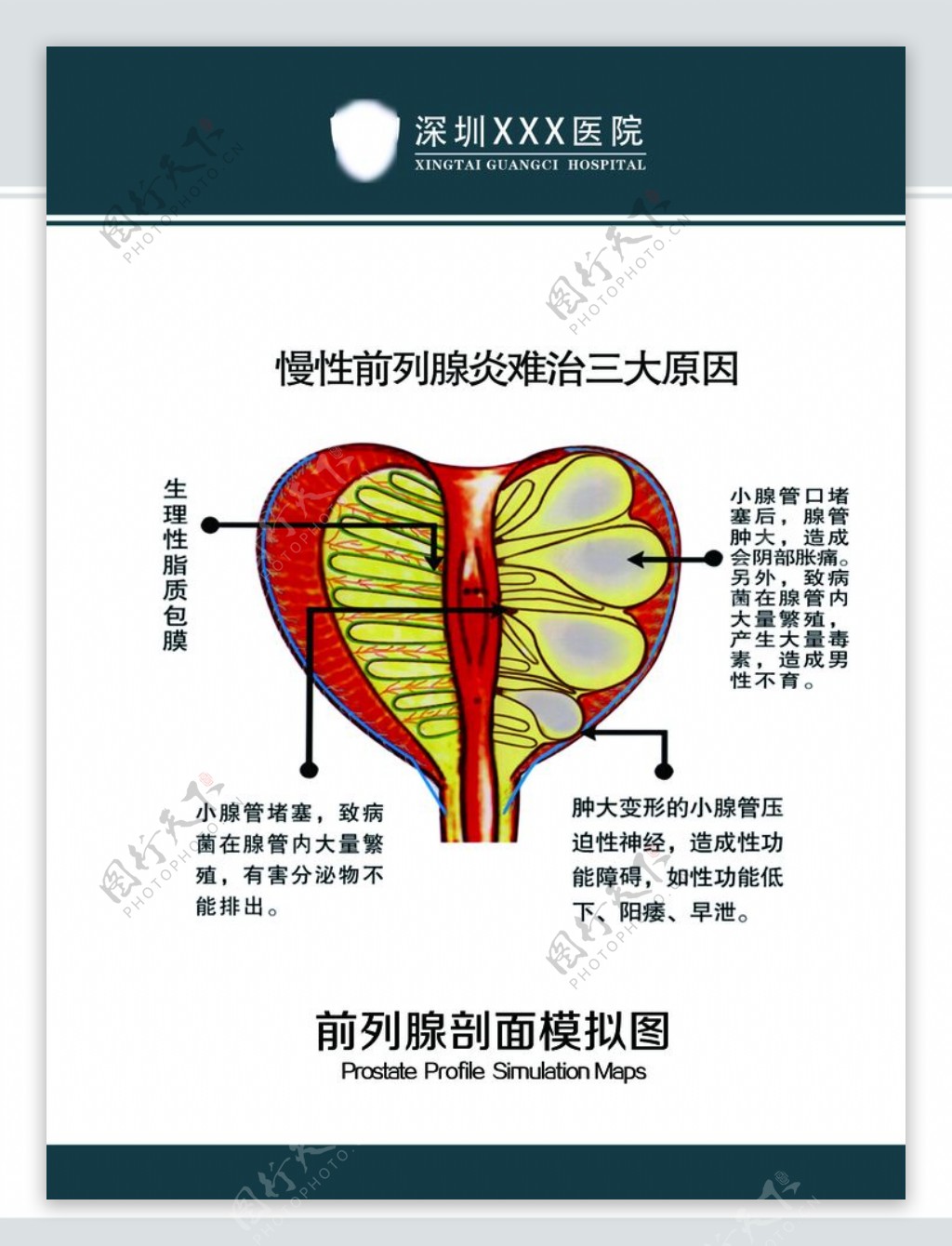 前列腺剖面模拟图图片